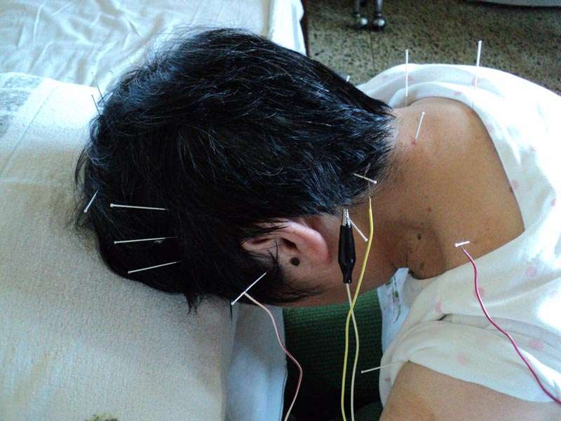 [图]神经性耳鸣的针灸,中药治疗