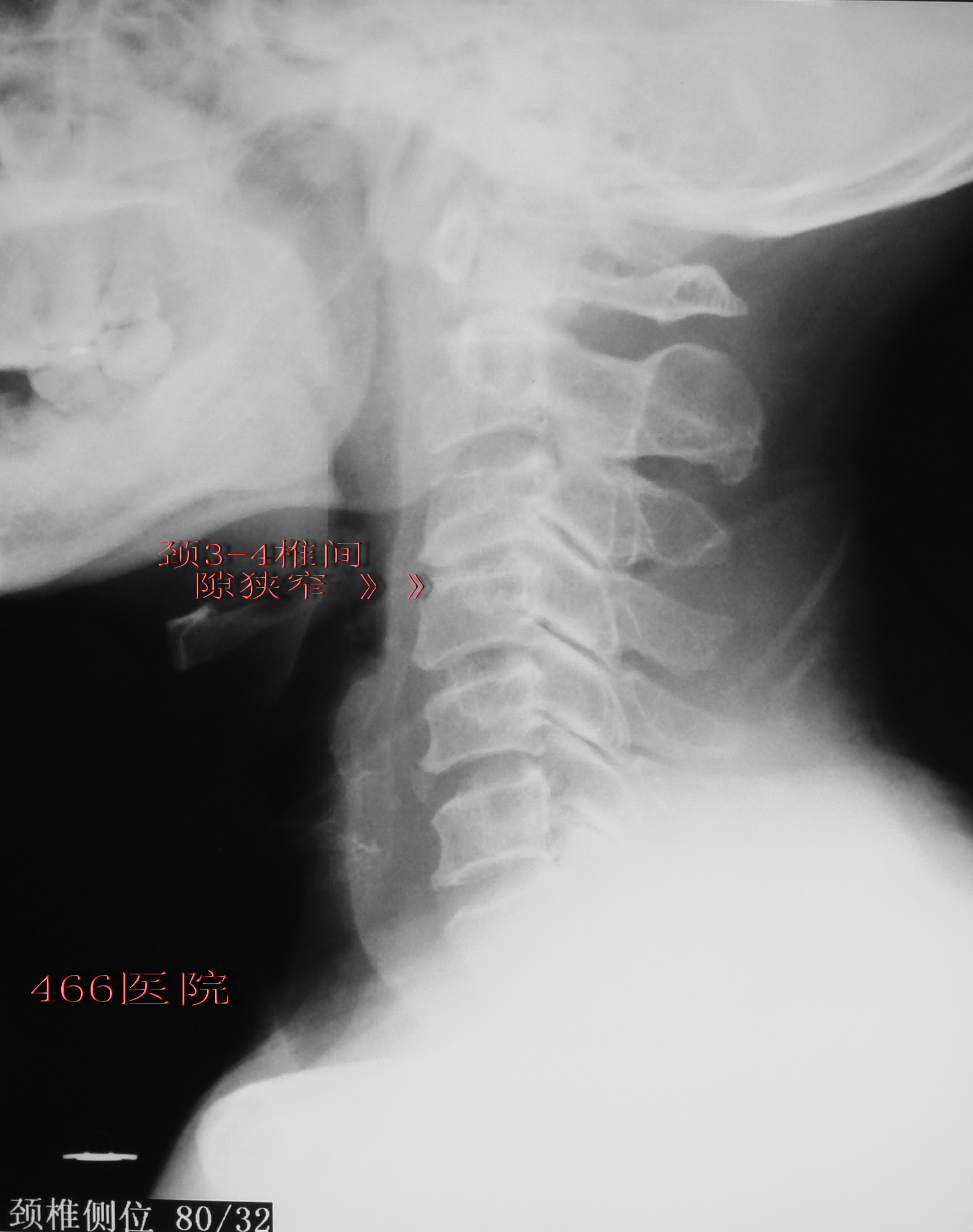 術後頸椎x線:cage固定確實術後患者右上肢疼痛症狀即刻緩解,術後一週