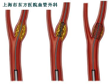 为什么得了中风要在颈部开刀? - 好大夫在线