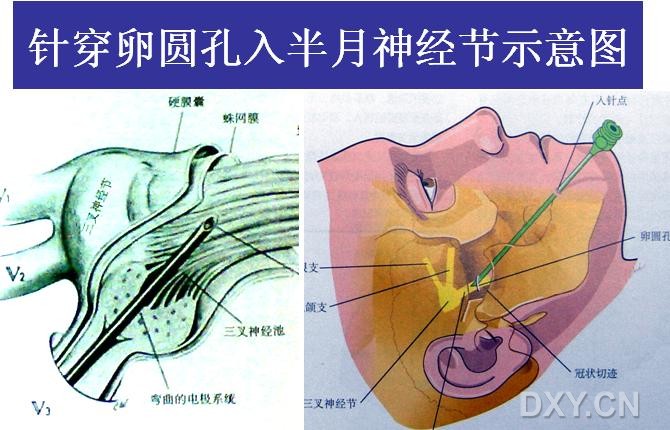 卵圆孔三叉神经图片