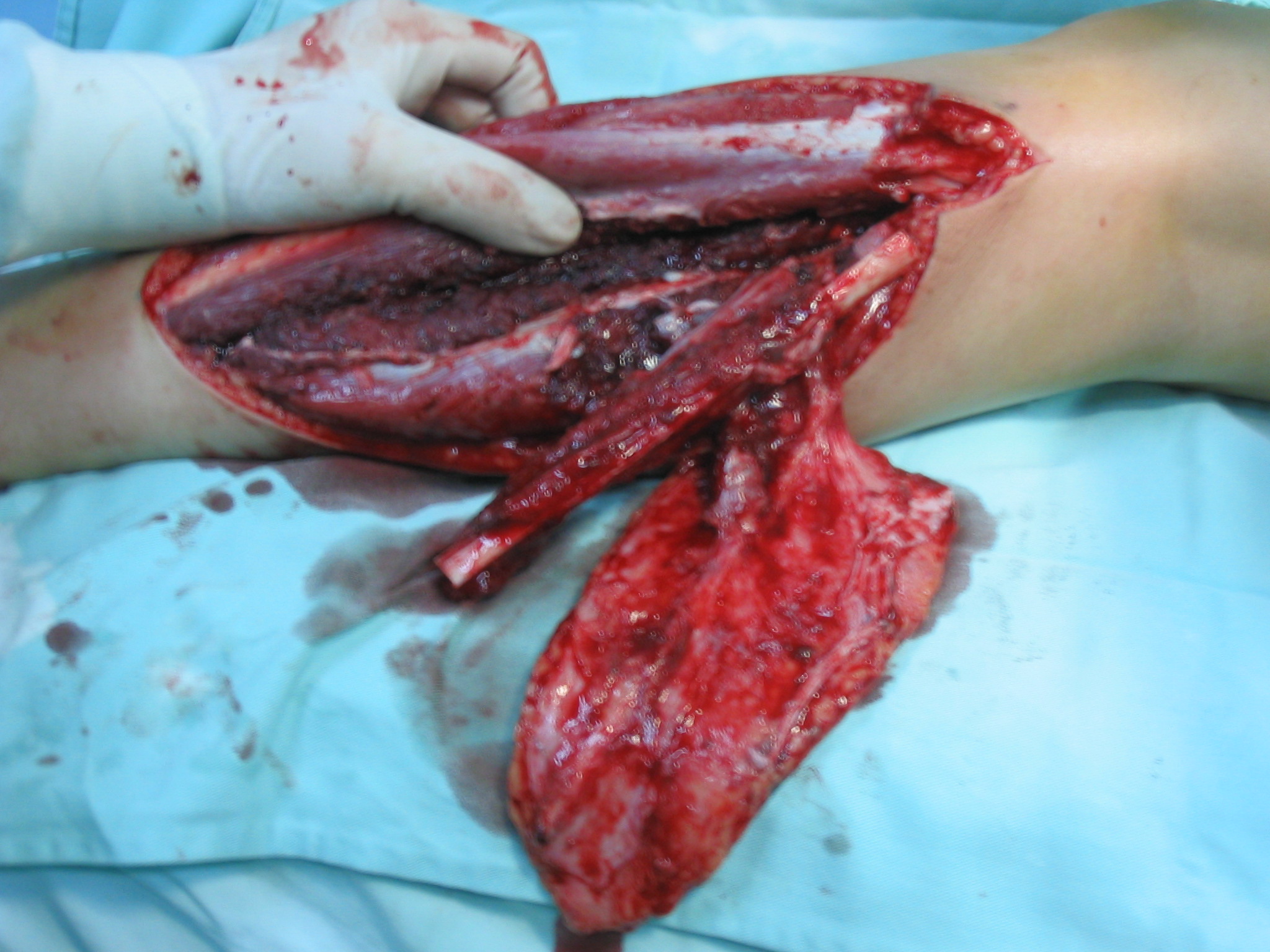 骨外露,骨髓炎的治疗: (1)腓骨皮瓣 - 好大夫在线