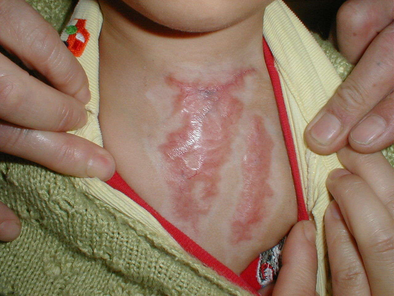 宝宝烫伤留下了瘢痕怎么办