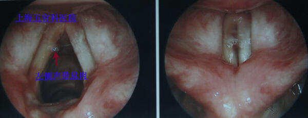 咽喉息肉图片早期图片