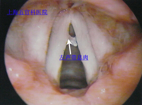 喉咙长息肉的症状图片