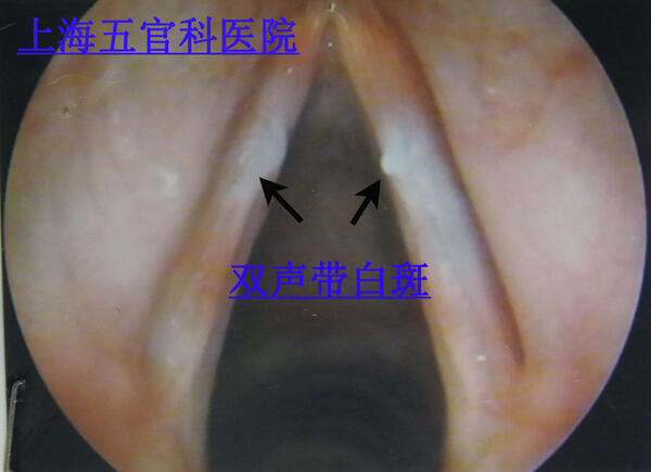 声带白斑治疗