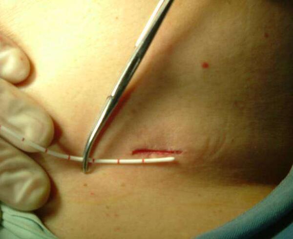 胆结石手术后疤痕图片图片