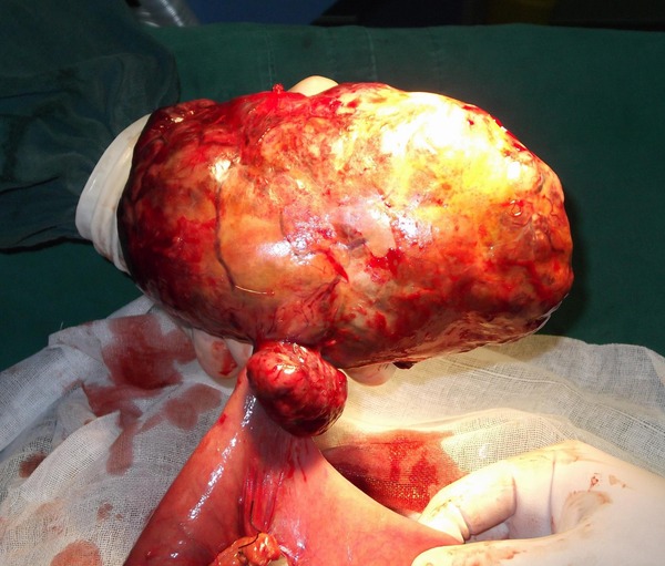 小肠间质瘤 - 好大夫在线