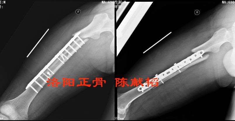 大腿骨折钢板固定失败再手术治疗