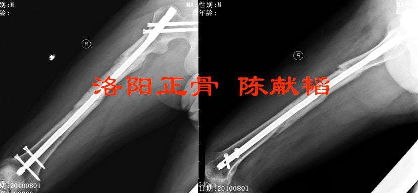 大腿骨折钢板固定失败再手术治疗
