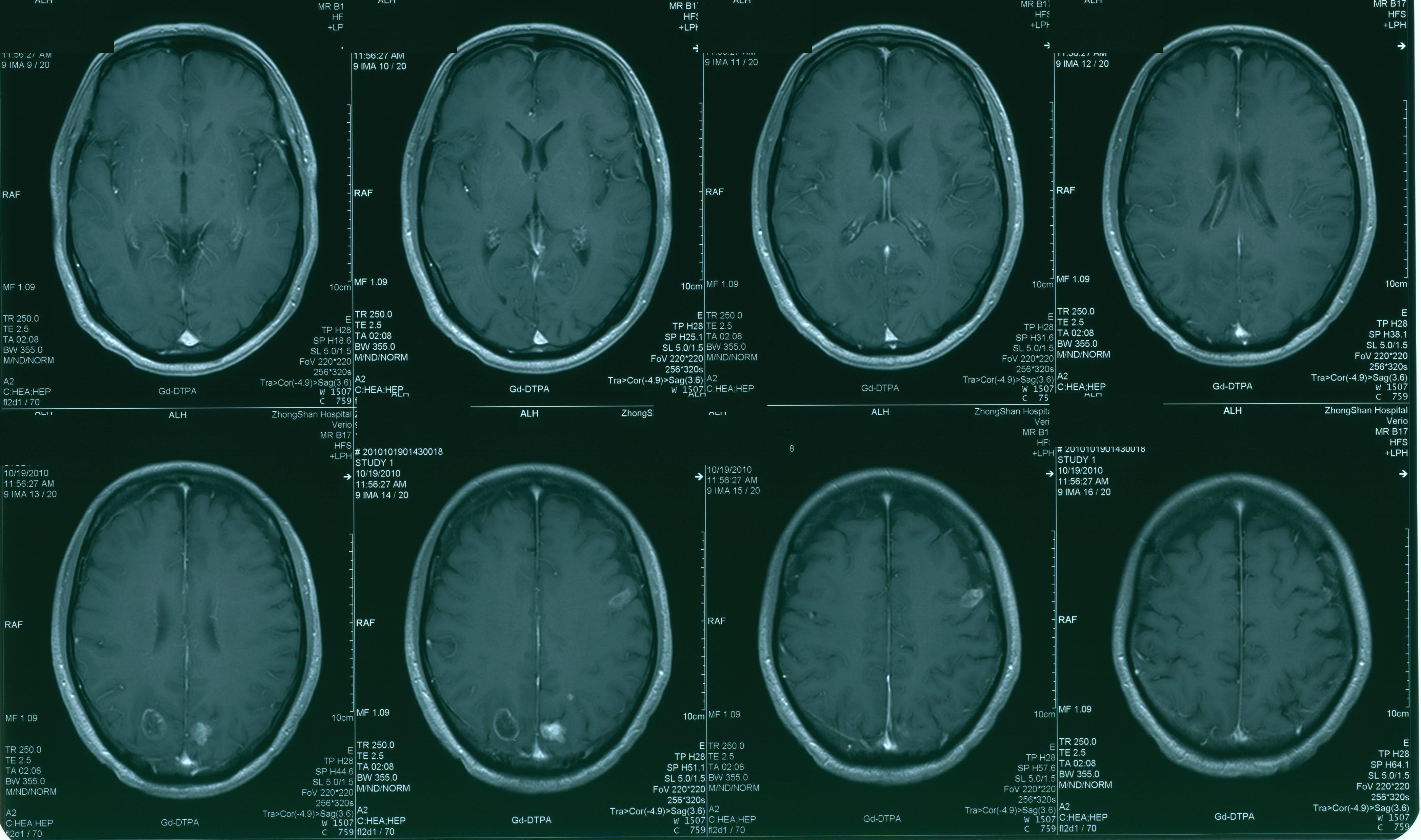 病人以手脚无力为首发症状,头部磁共振(mri)检查发现脑内多发转移瘤