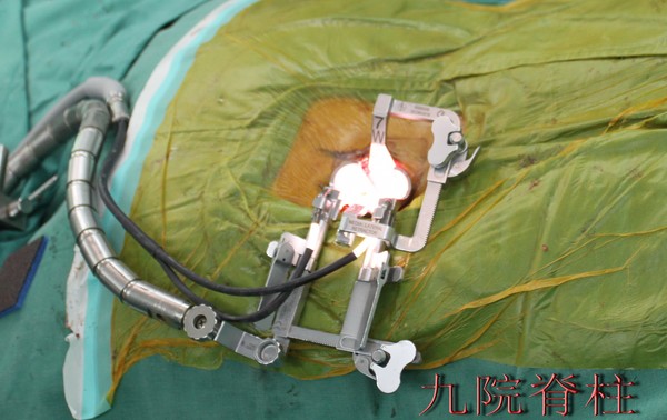 采用美国美敦力公司生产的可扩张通道手术系统(mast quadrant&