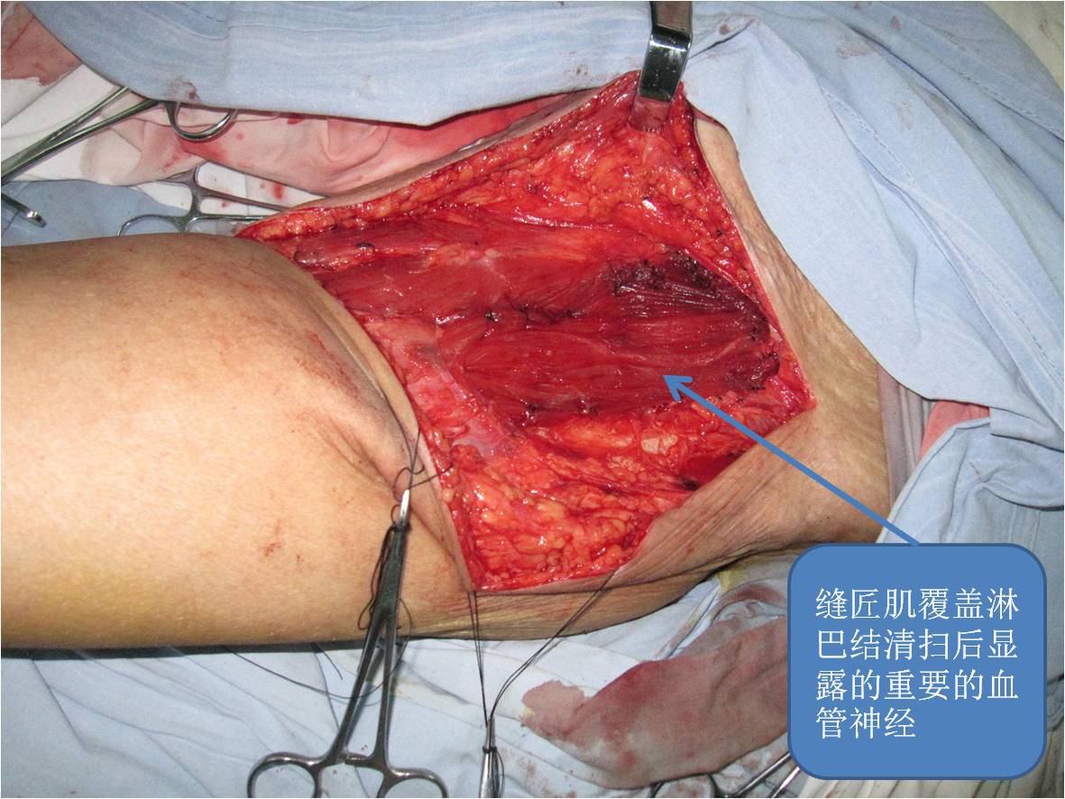 恶性黑色素瘤的腹股沟淋巴结清扫手术过程