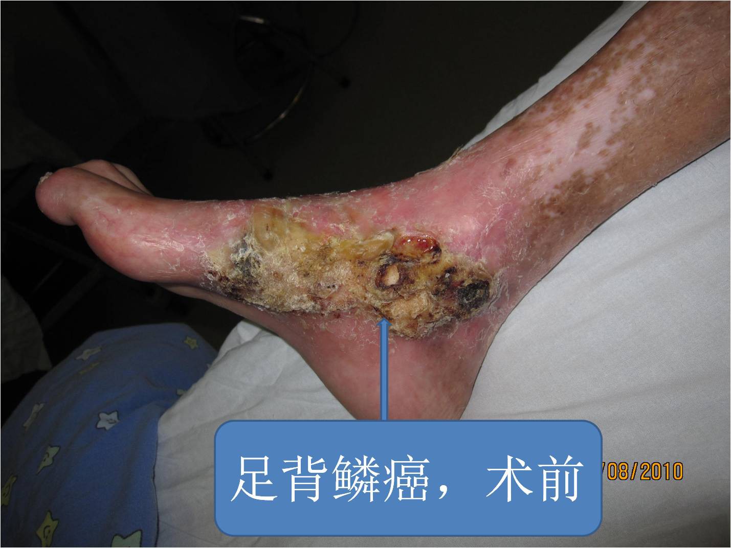 鳞癌的扩大切除手术过程 - 好大夫在线