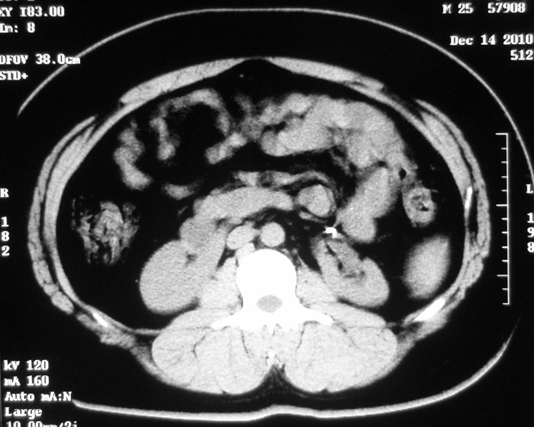 腹腔鏡馬蹄腎積水v-y成型術