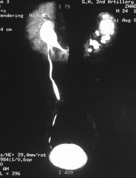 腹腔鏡馬蹄腎積水vy成型術