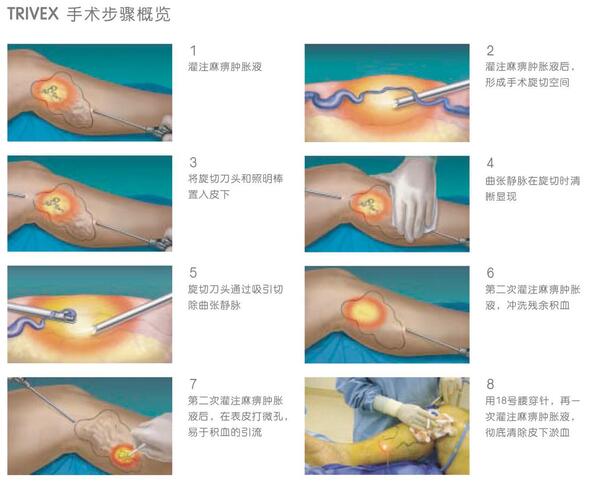 下肢静脉曲张手术图解图片
