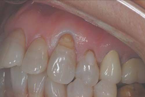 给患者介绍一种牙体疾病: 楔状缺损