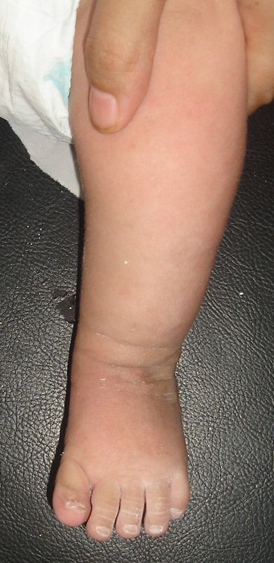 新生儿期就开始治疗马蹄足是我院的特色,越早治疗效果越好,欢迎联系