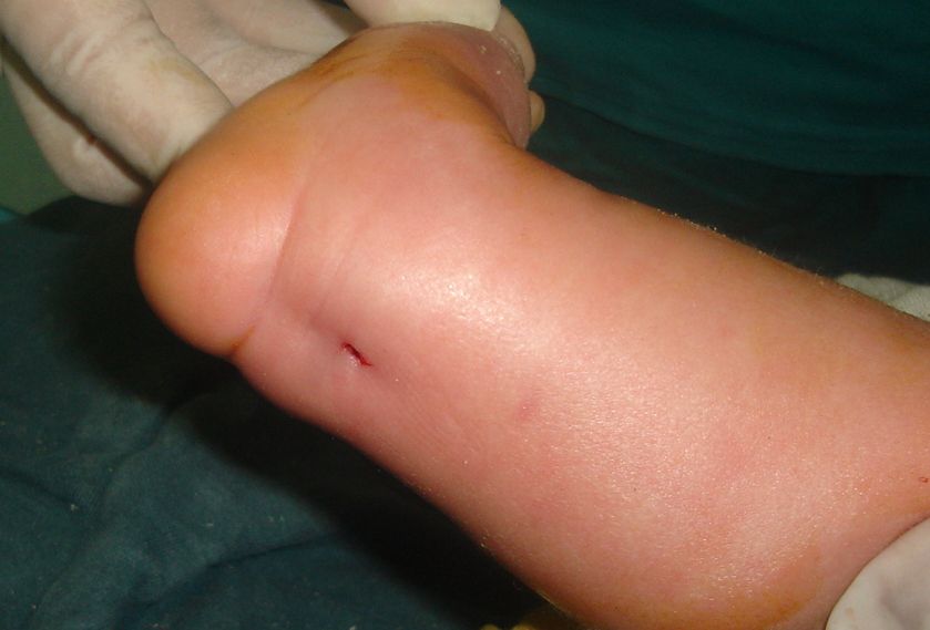 ponseti法治疗马蹄足患儿照片_先天性足畸形_疾病介绍_介绍 - 好大夫