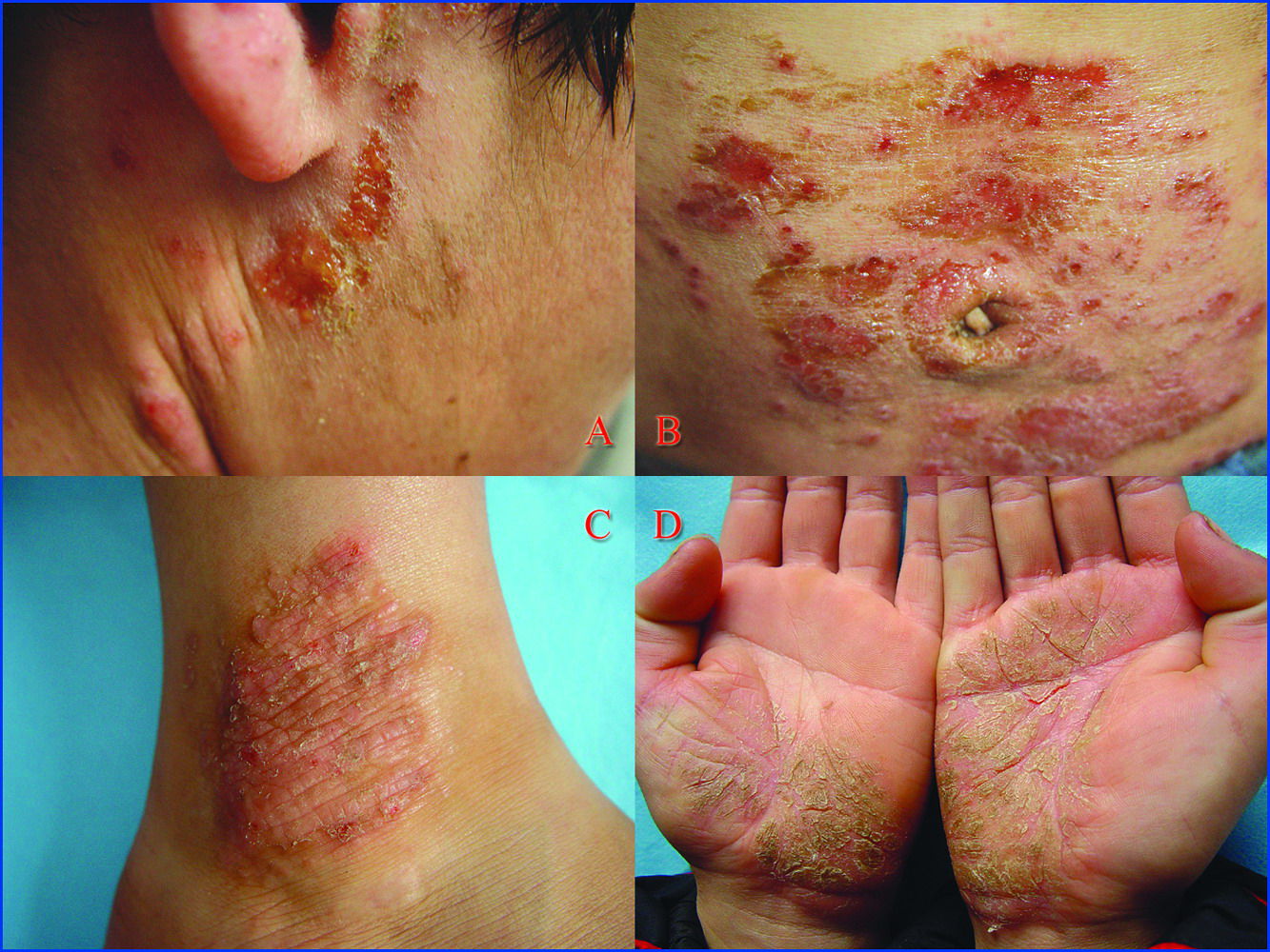 eczema)由急性湿疹及亚急性湿疹迁延而成,或自一开始炎症不重,暗红斑