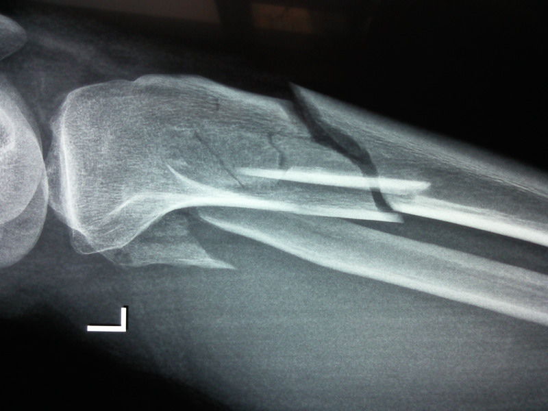 图片 胫骨近端粉碎性骨折的手术治疗