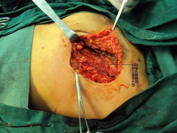 转移背阔肌肌瓣一期成形在乳腺手术中的应用
