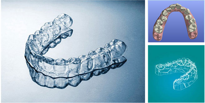 无托槽隐形矫治技术
