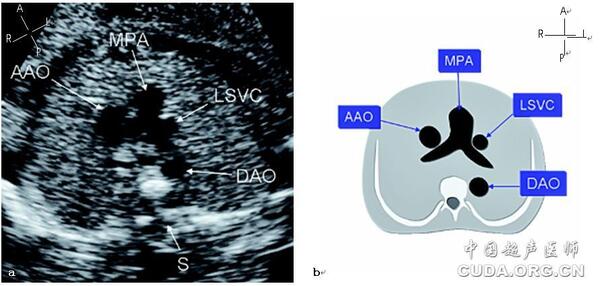 14 23孕周有永存左上腔靜脈伴右上腔靜脈缺如的胎兒超聲圖像:三條血管