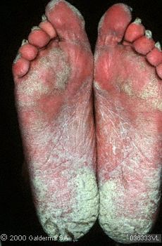 中药浸泡法治疗"鹅掌风""脚湿气" - 好大夫在线