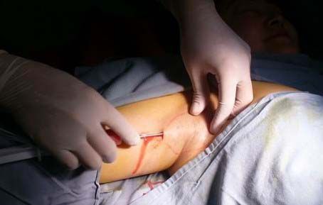 吸刮法,适合轻度腋臭)刮吸法于20世纪80年代日本开始应用,其手术效果