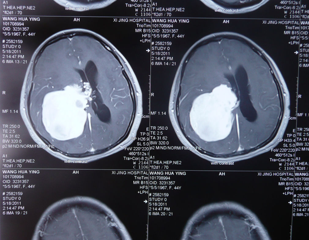 经典手术:脑室三角区巨大脑膜瘤手术治疗! 