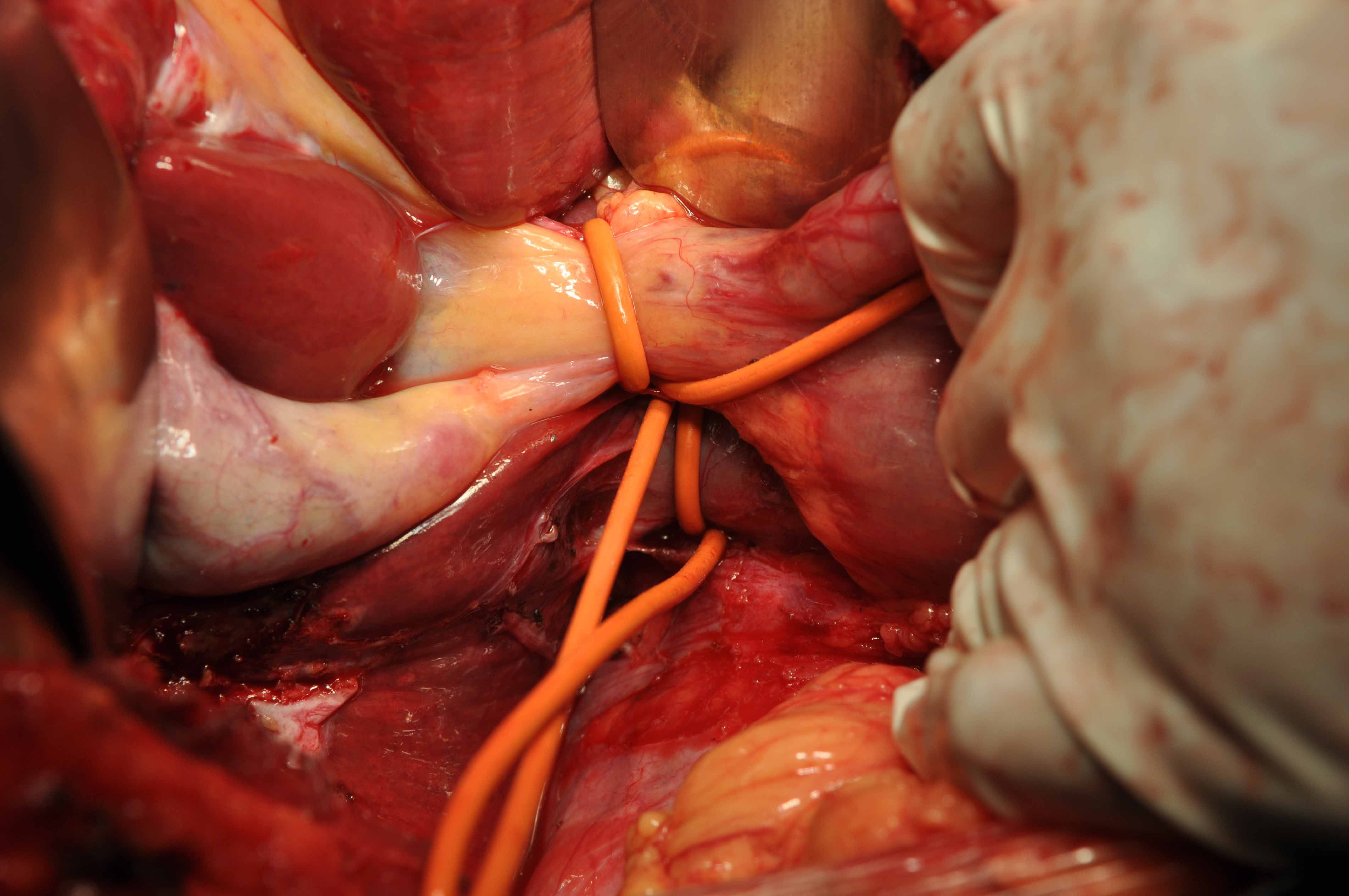 特殊部位且手术风险很大的肝血管瘤(如尾状叶下腔静脉旁的),考验医生