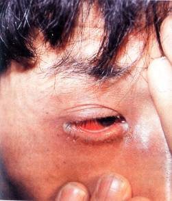     淋病的病原体为淋病双球菌,主要为直接性接触传染