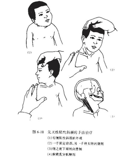 先天性斜颈的保守治疗