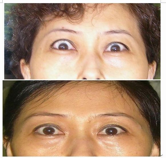 突眼典型病例治疗前后照片对照(图) - 好大夫在线