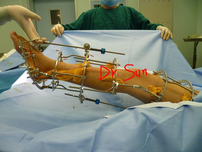 ilizarov外固定架同期纠正僵硬型马蹄足与膝关节屈曲挛缩 - 好大夫