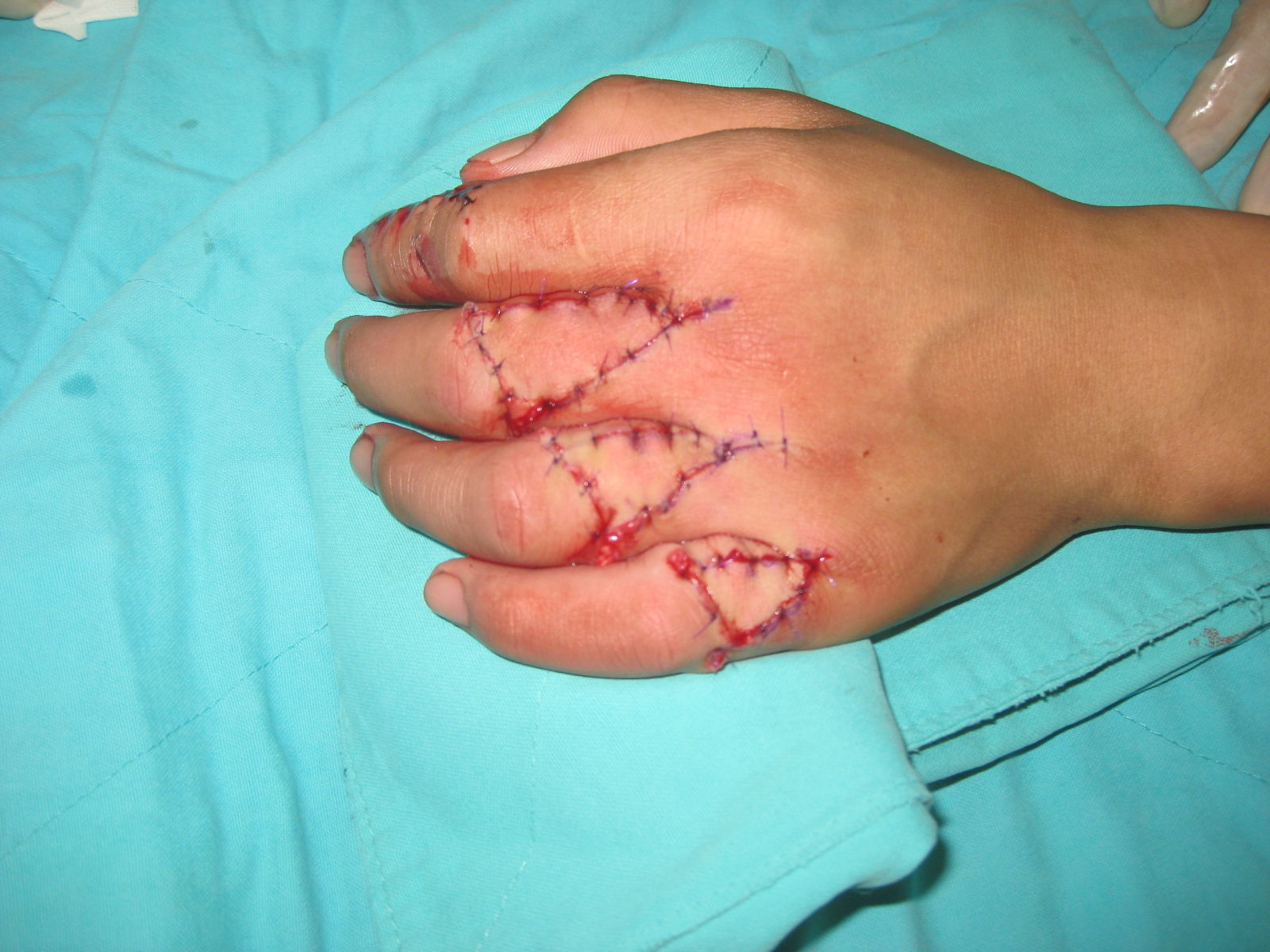 指动脉不同节段背侧皮支为蒂的v-y推进皮瓣修复同指指背皮肤缺损 - 好