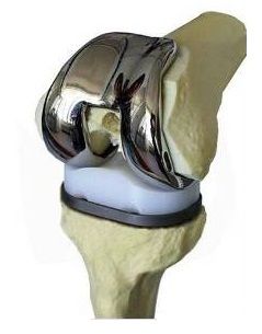 人工膝关节置换费用图片