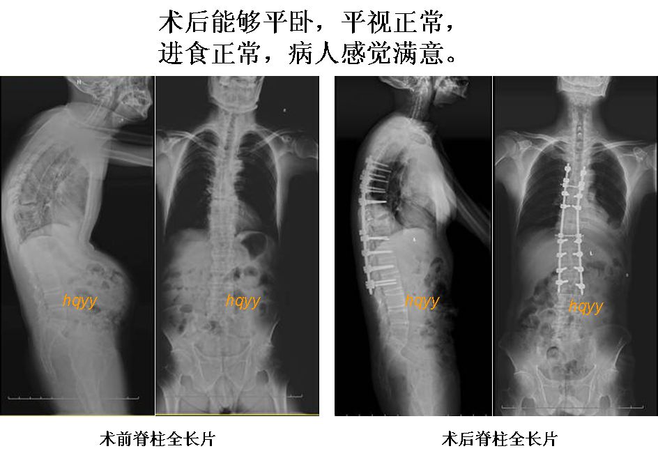 强直性脊柱炎重度脊柱驼背畸形的手术矫治