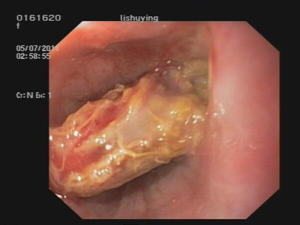 食管异物致食管纵隔瘘,纵隔脓肿形成