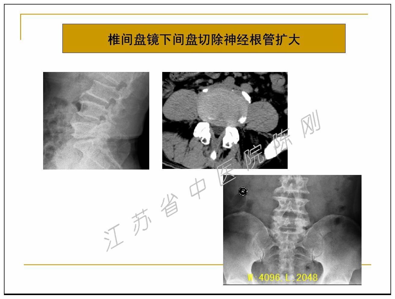 腰椎管狭窄症的治疗选择及其微创手术 附图片