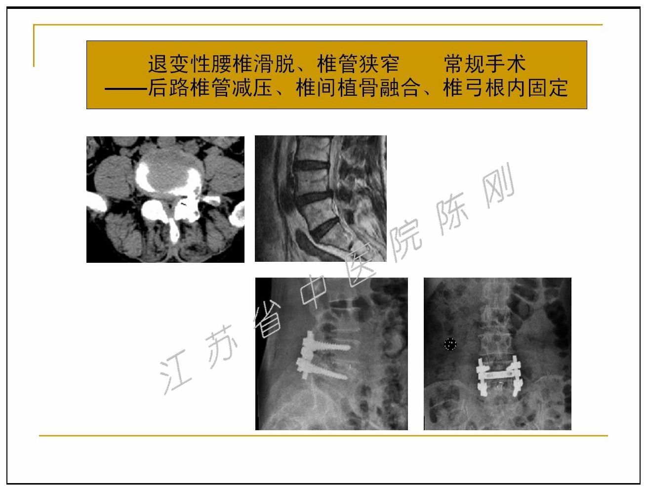 腰椎管狭窄症的治疗选择及其微创手术 附图片