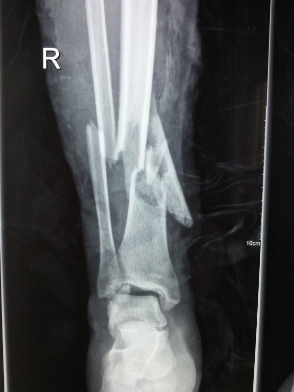 图片 左胫腓骨开放性骨折内外固定结合手术治疗 骨折 骨折治疗方法