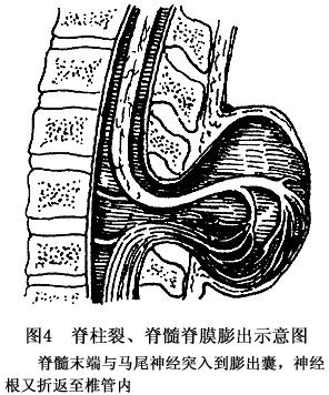 脊柱裂脊膜膨出脊髓拴系