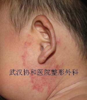 口服心得安治疗血管瘤照片1
