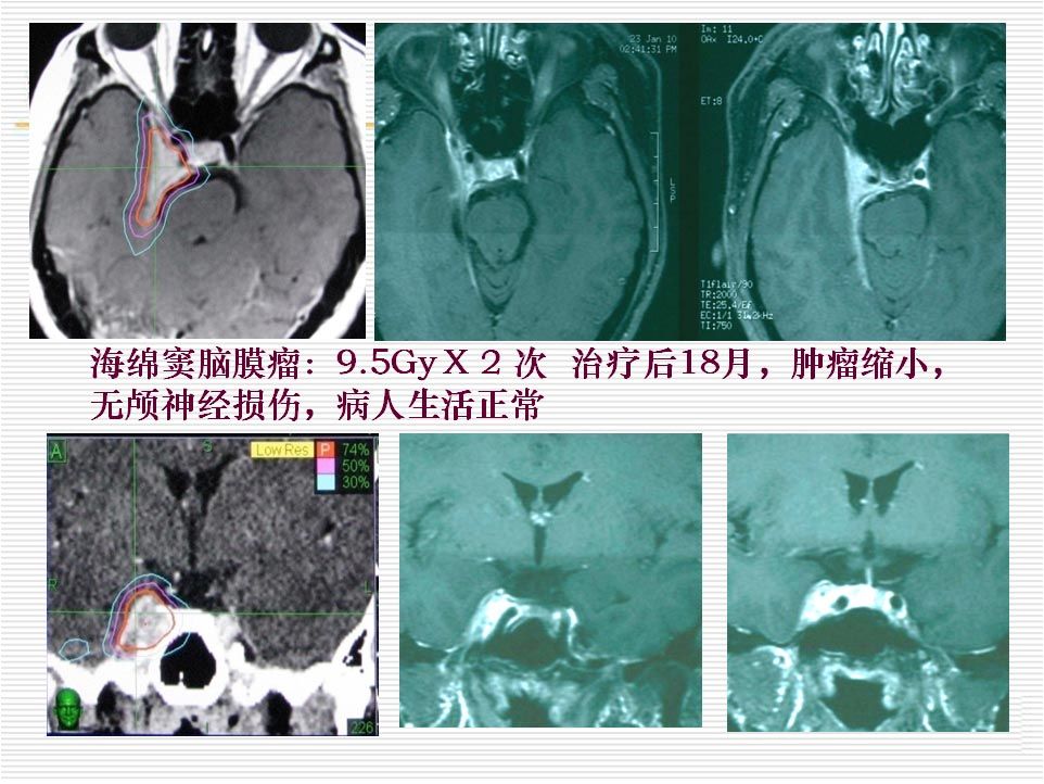 射波刀在神经外科的应用