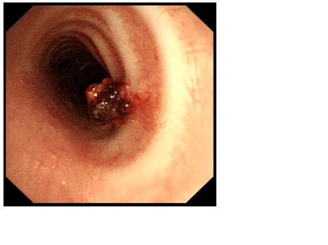 气管肿瘤的早期症状图片