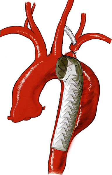 治疗主动脉弓部病变 "复合手术"技术临床应用经验分享 - 好大夫在线