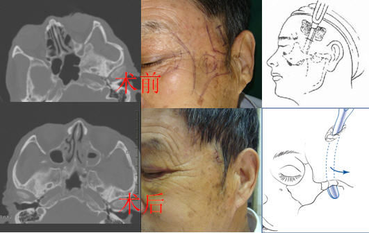 颧弓骨折的微创治疗 
