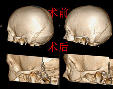 颧弓骨折的微创治疗 